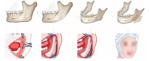 下颌角手术过程