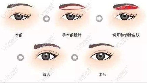 切眉手术改善较重的眼皮松弛