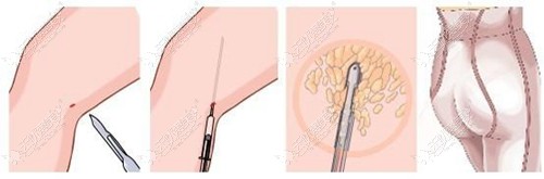 大腿吸脂手术过程