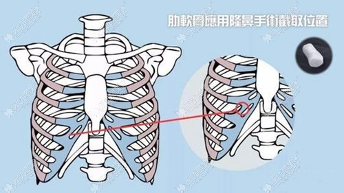 肋软骨隆鼻取肋骨部位