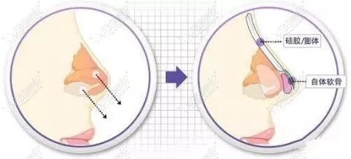 花4万元做了膨体半肋隆鼻贵吗?担心膨体隆鼻会一年比一年矮