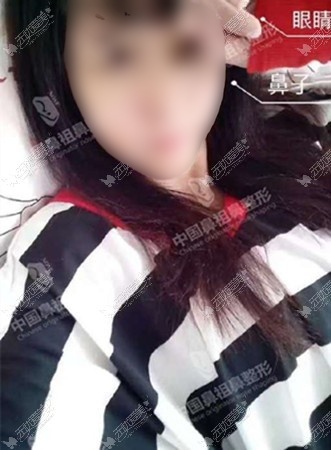 北京鼻祖双子塔鼻综合用双侧耳软骨隆鼻比单侧效果好