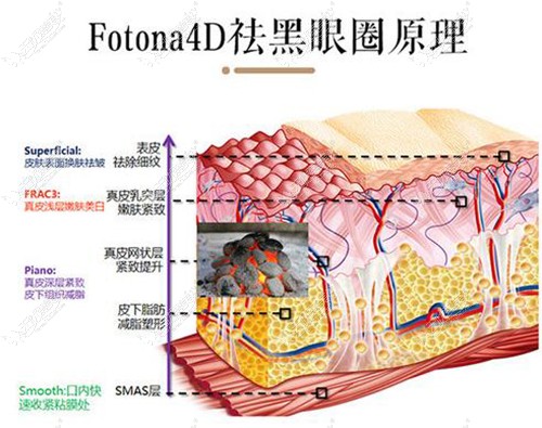 Fotona 4D pro祛黑眼圈原理