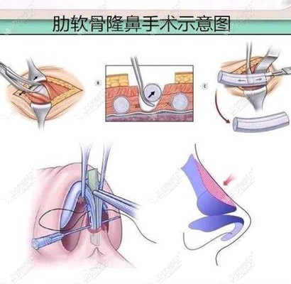 肋骨鼻修复过程