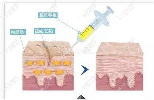 下眼睑凹陷可以填充自体脂肪改善