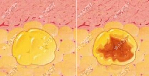 吸脂后造成面部有疙瘩的原因