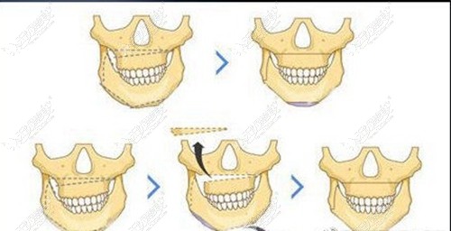 正颌手术改善下颌骨不对称