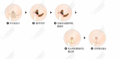 隆胸棒棒糖原理图片