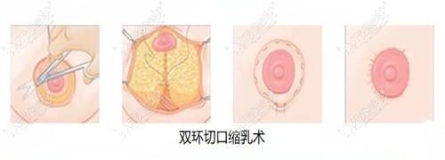 乳房悬吊双环法手术过程