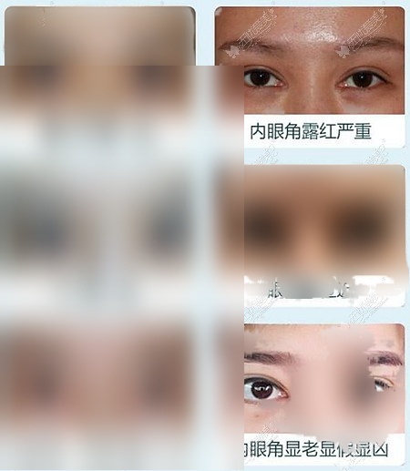 北京的魏志香医生修复内眼角怎么样?我内眼角开大了想找她