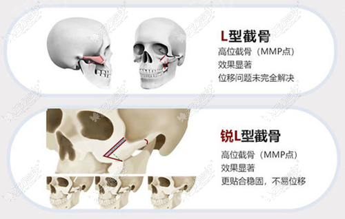 赵贵庆颧骨内推手术技术优势