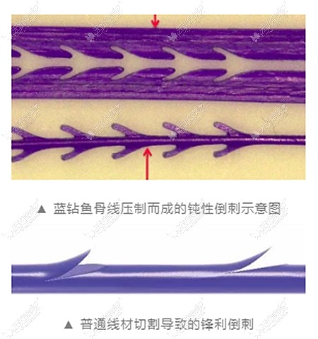 强生鱼骨线的优势