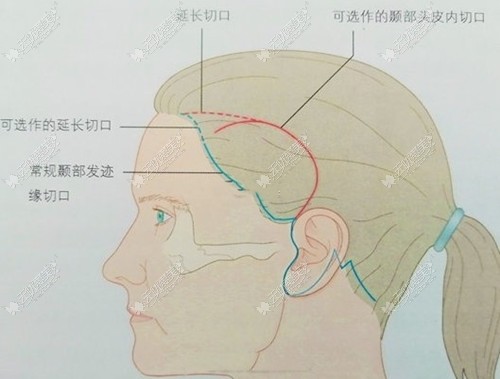 大拉皮手术过程