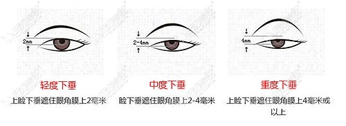 用额肌瓣悬吊术改善上睑下垂的后不能眨眼，这纯属诽谤