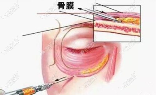 双美胶原蛋白填充泪沟的层次