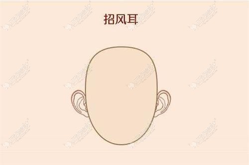 30岁单侧招风耳找广州余文林做耳朵矫正手术后会反弹吗?