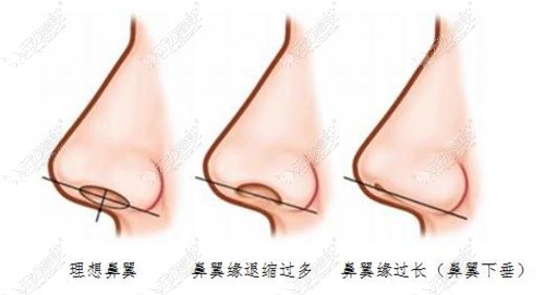 鼻翼缘退缩打玻尿酸能改善吗