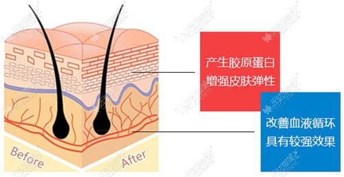 蛋白线埋入的组织