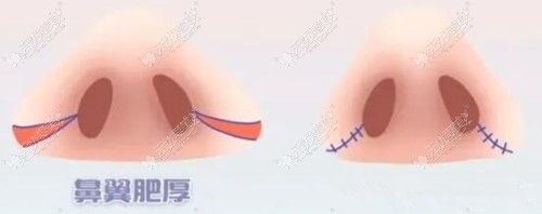 鼻翼外切缩小过程图