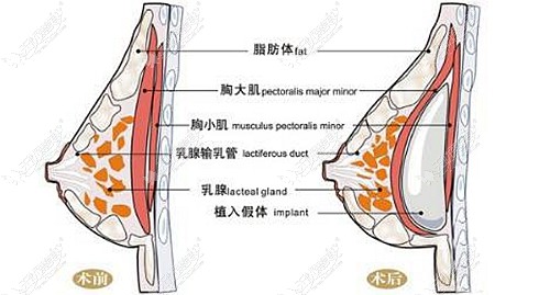 出彩仿真极速丰胸的原理