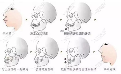 骨性龅牙正颌手术过程