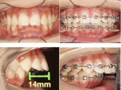 重度骨性龅牙正畸3个月才内收4mm证明还是做正颌效果好