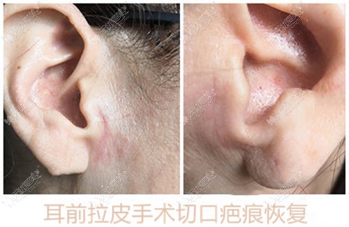 手术拉皮耳边疤痕恢复图片