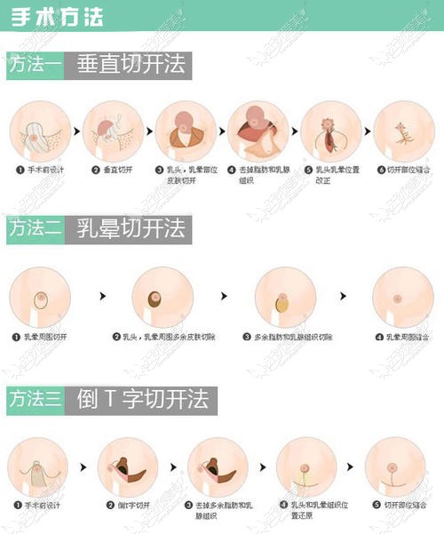 大胸提升手术的三种方法