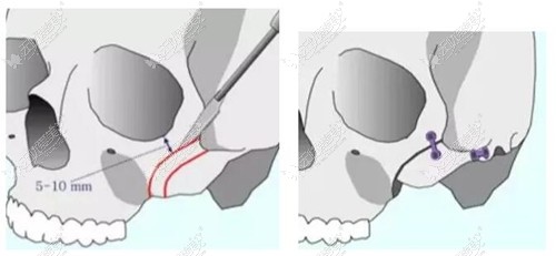 颧骨内推手术对骨头折断内推