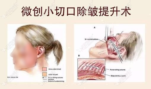 小拉皮手术原理