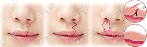唇腭裂二期修复不同瘢痕问题