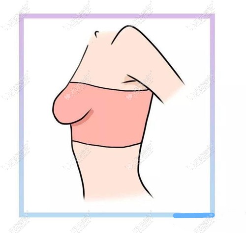 分析完人工韧带乳房提升利弊后发现这种下垂矫正术挺安全