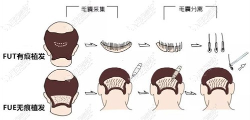 什么是fue植发