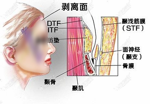 pst面部提升手术需要进行剥离