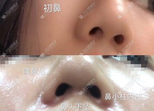 隆鼻后鼻小柱挛缩要不要加筋膜修复,得看皮肤张力情况考虑