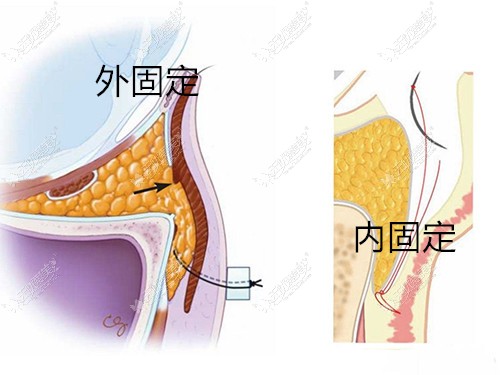 眶隔脂肪内固定外固定区别