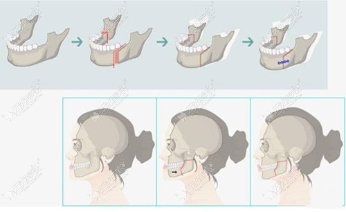正颌手术过程