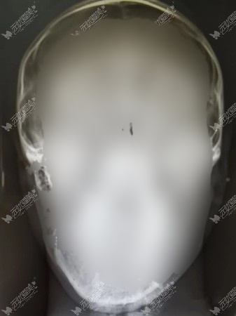 脸歪拍摄CT可以判断是骨性偏颌