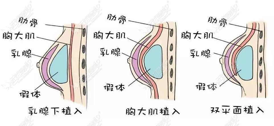 假体隆胸植入层次