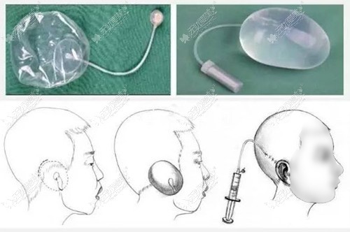 小耳畸形手术全包过程