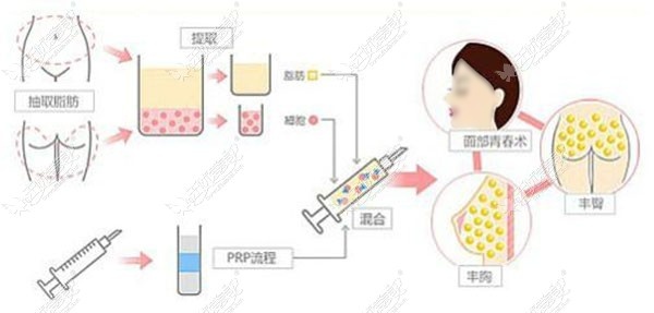 自体脂肪丰胸