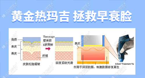 热玛吉去眼部皱纹