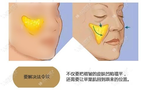 玻尿酸填充法令纹