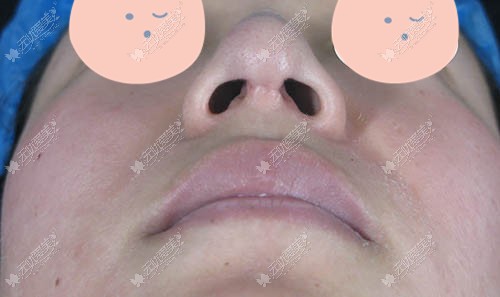 隆鼻增生是什么样子的图片