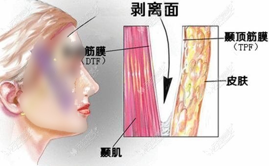 小拉皮手术切口