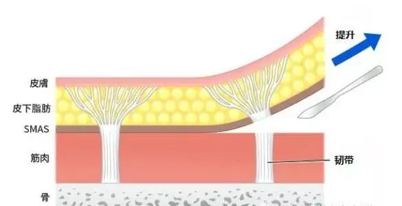 拉皮提升到筋膜层