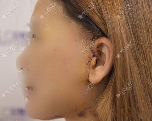 面部拉皮手术的切口位置