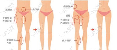 大腿内侧吸脂一个月皮肤看着有点不平,后期会慢慢恢复吗?