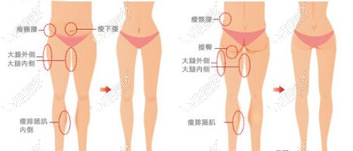 大腿内侧吸脂