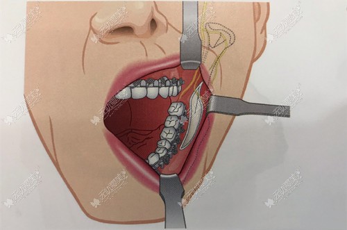 下颌角手术在口内进行